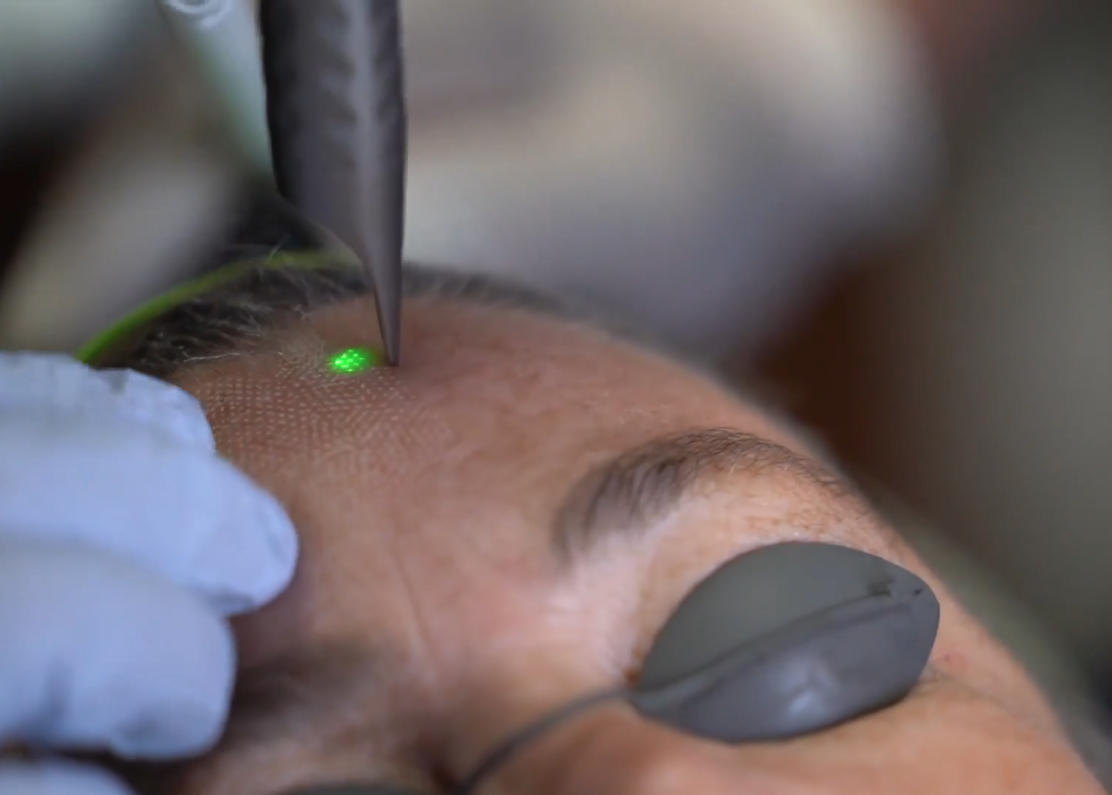 Laser Peel Treatment