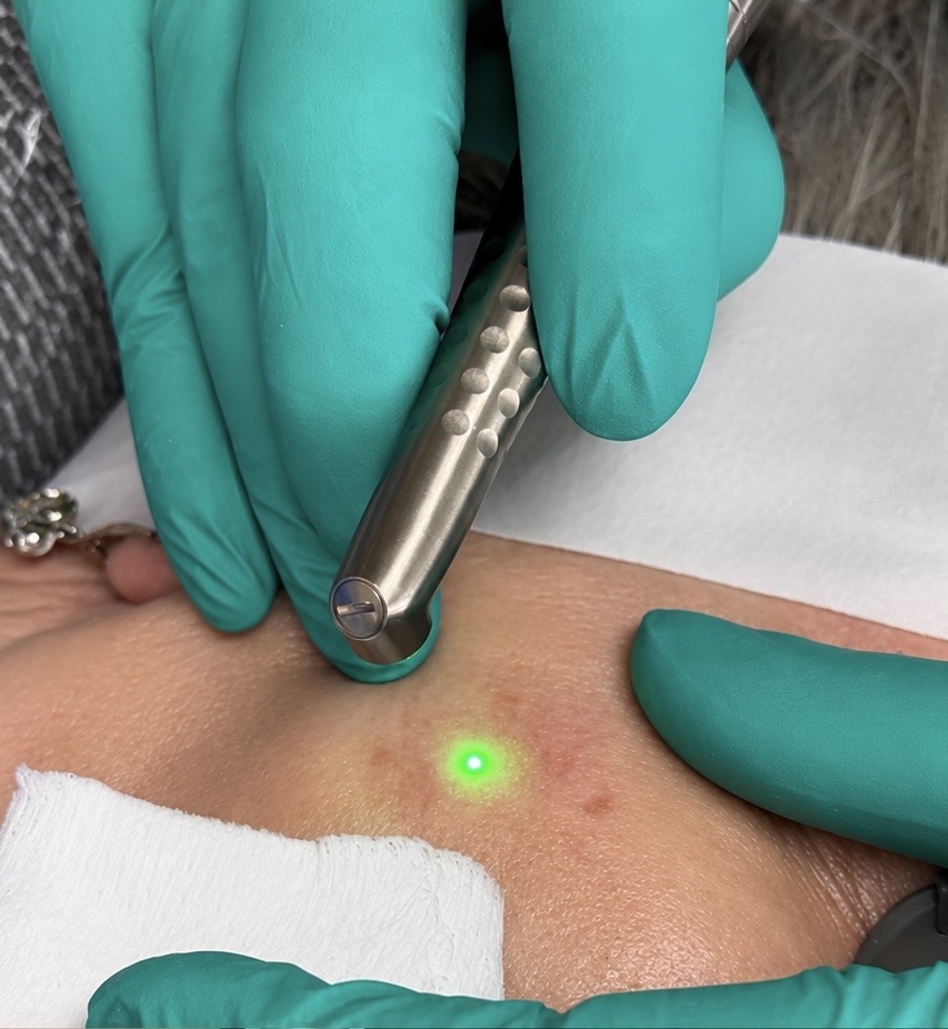 Age Spot and Mole Removal