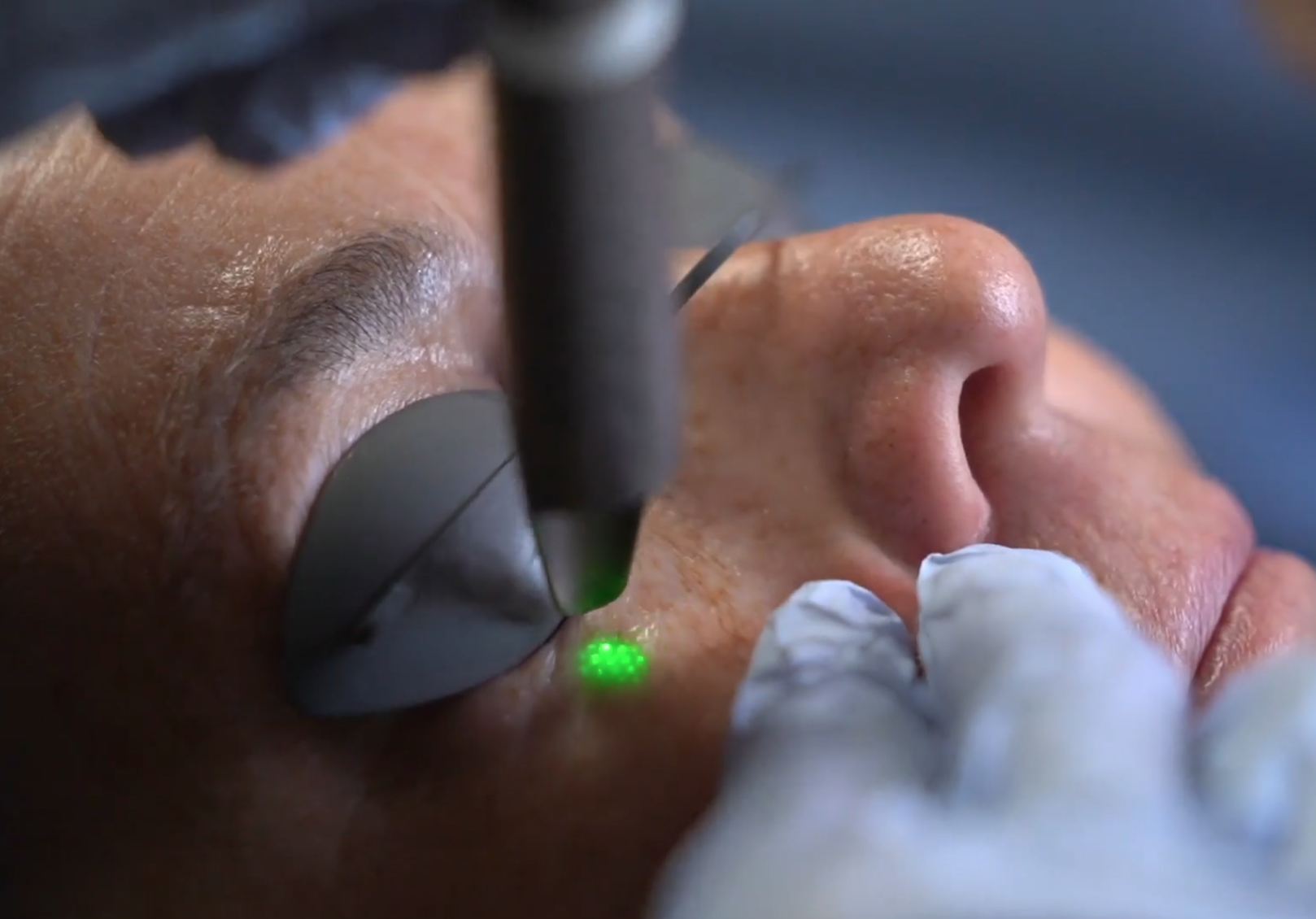 Under-Eye Lasering