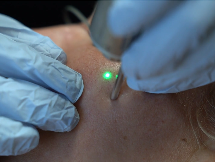 Vein Removal Treatment